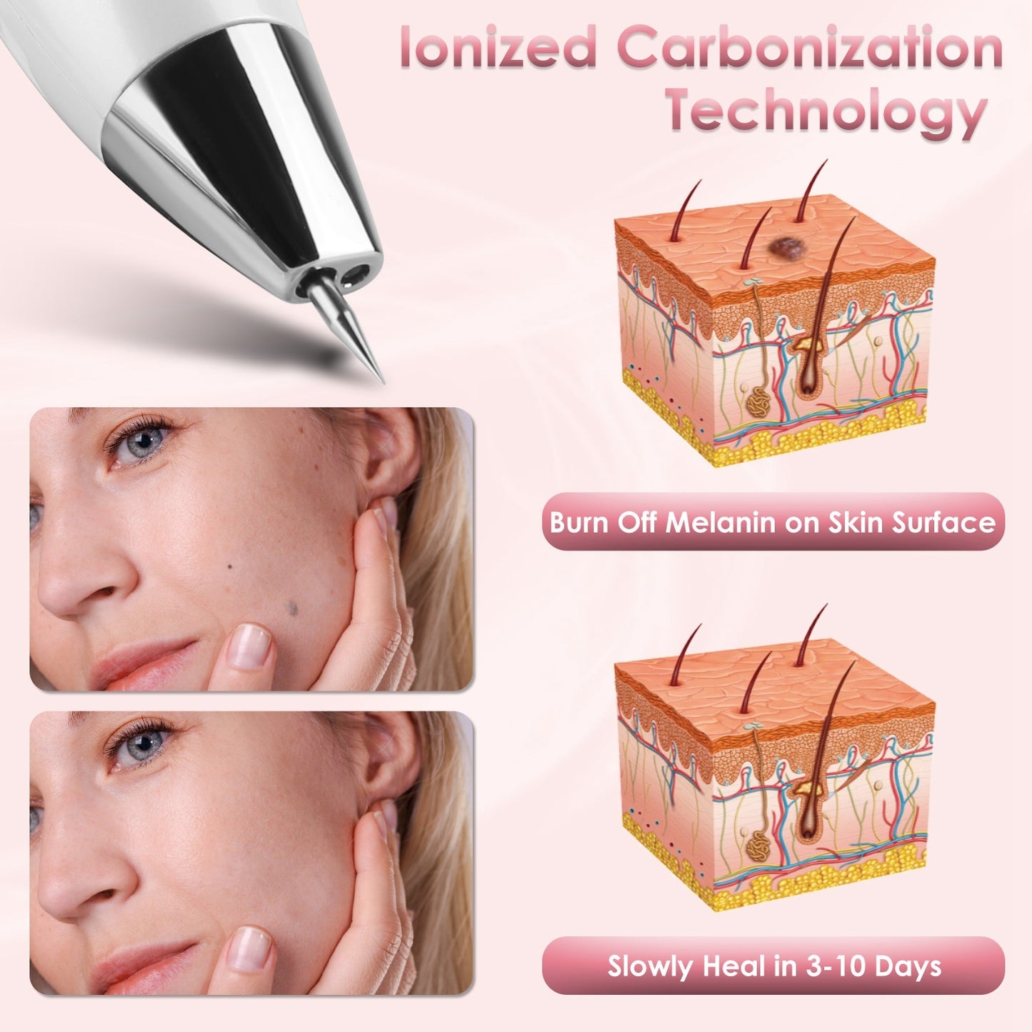 1Pc Skin Tag Remover Skin Tag Repair Kit Tattoo Freckle Wart Mole Remover Pen With 9 Intensity Levels 10 Fine Needles 3 Coarse Needles