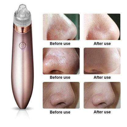 Electric Blackhead Vacuum Pore Cleaner Acne Pimple Remover Strong Suction Tool Electric Blackhead Remover Pore Vacuum Suction Diamond Dermabrasion Face Cleaner - DropOnline.co