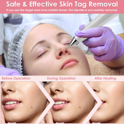 1Pc Skin Tag Remover Skin Tag Repair Kit Tattoo Freckle Wart Mole Remover Pen With 9 Intensity Levels 10 Fine Needles 3 Coarse Needles - DropOnline.co
