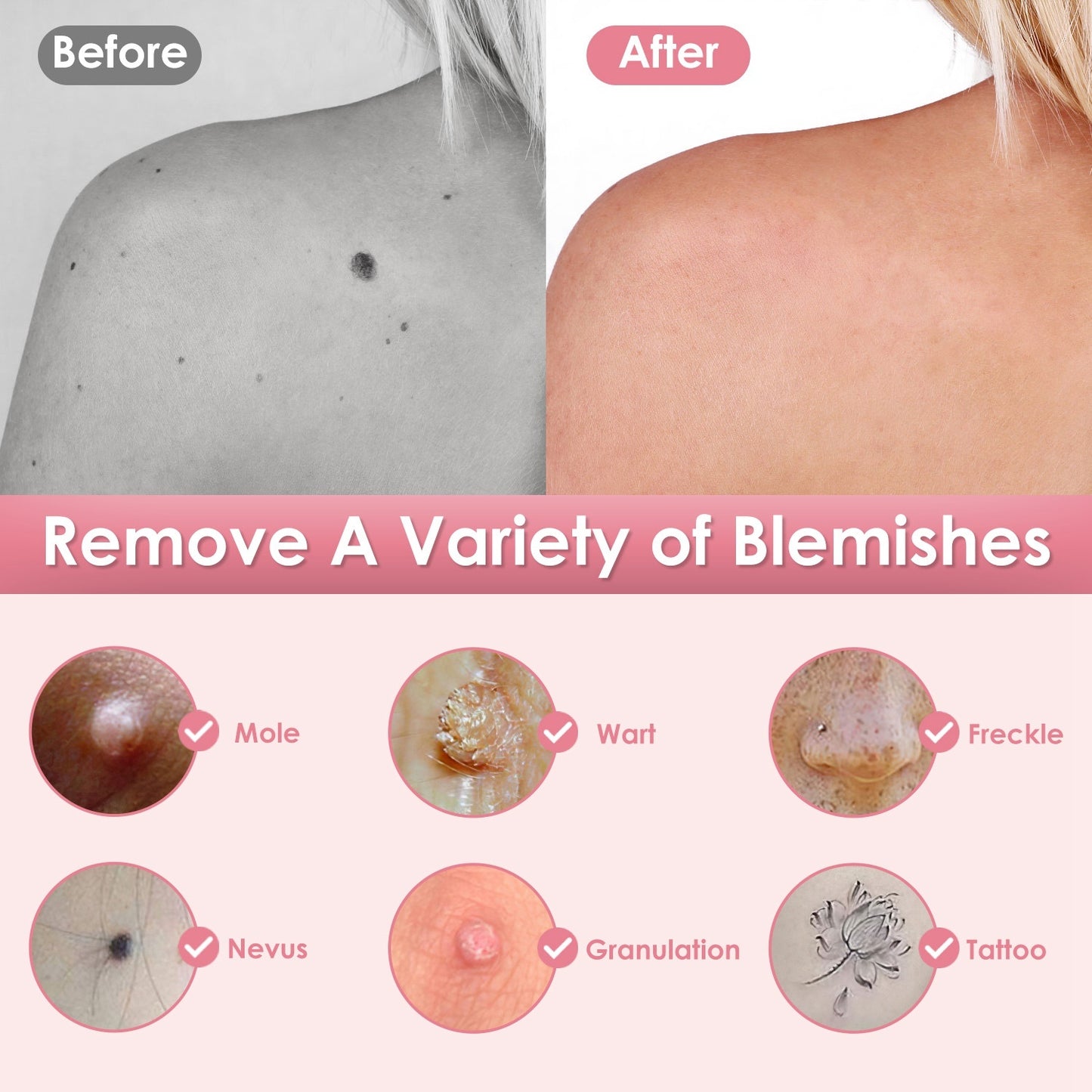 1Pc Skin Tag Remover Skin Tag Repair Kit Tattoo Freckle Wart Mole Remover Pen With 9 Intensity Levels 10 Fine Needles 3 Coarse Needles