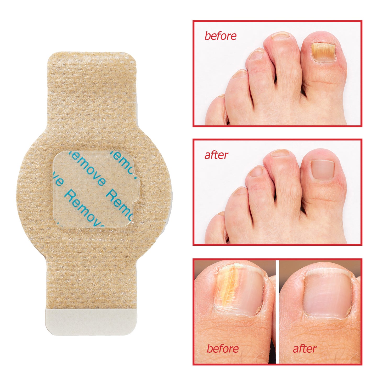 Nail Antibacterial Patch